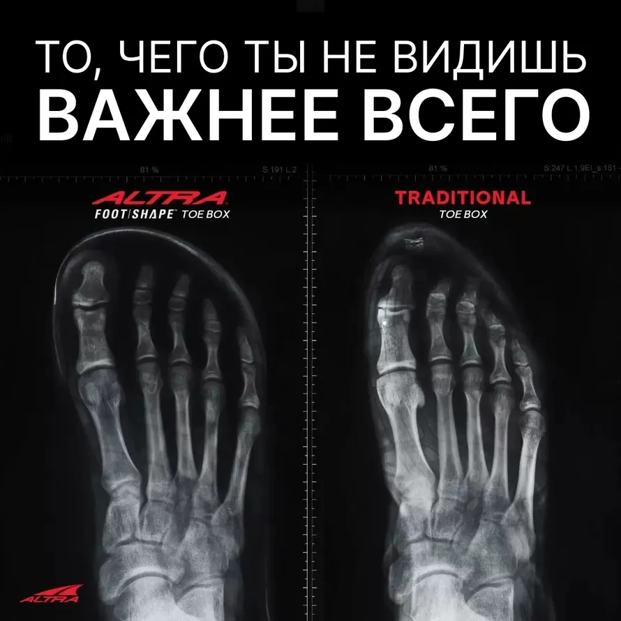Сравнительные рентгеновские снимки ноги в обычном кроссовке и в кросссовке компании ALTRA